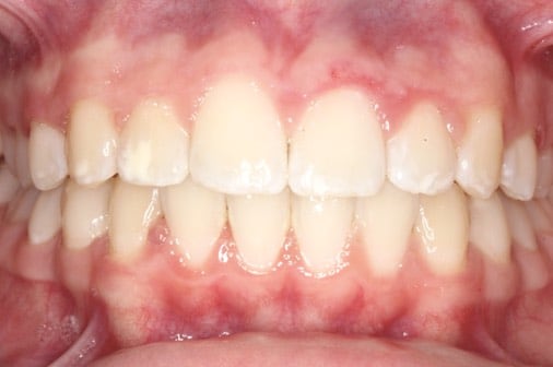 After clear braces, straight smile, Milk Orthodontics Auckland