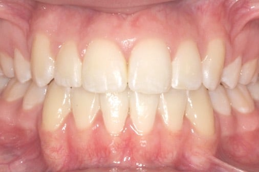 After classic braces, beautiful aligned smile, Milk Orthodontics Auckland