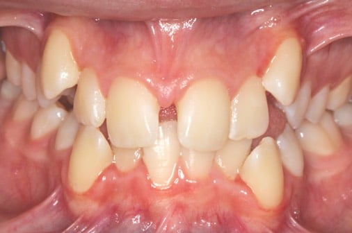 Before classic braces treatment, Milk Orthodontics Auckland