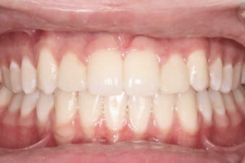 After classic braces bringing through an impacted canine, Milk Orthodontics Auckland