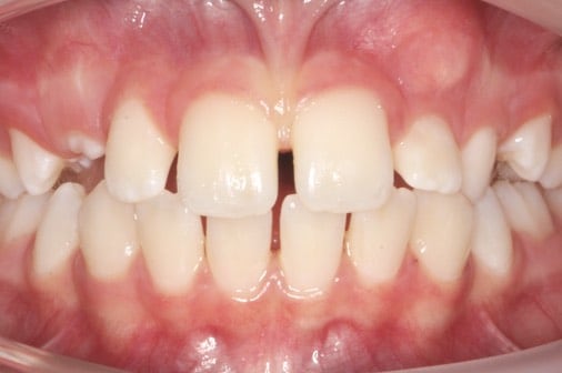 Before treatment of an impacted canine, Milk Orthodontics Auckland