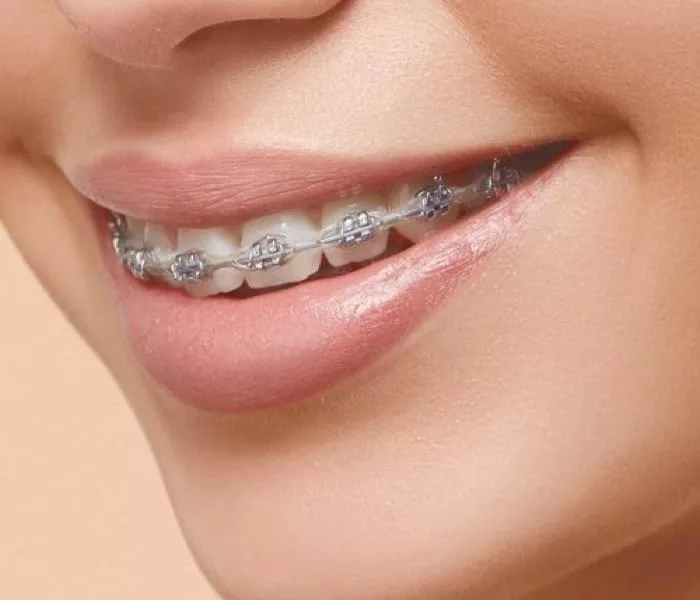 Classic metal braces at Milk Orthodontics Auckland