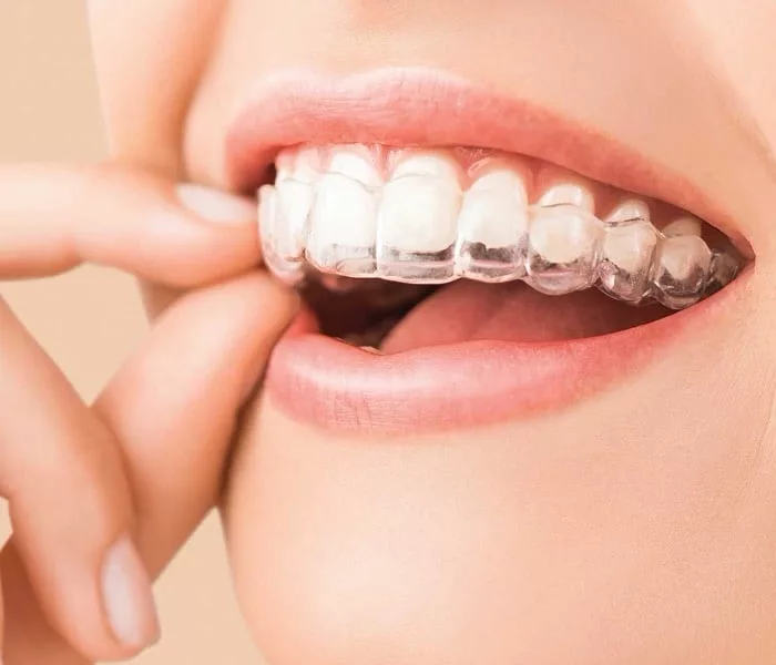 Clear aligners, discreet removable trays, at Milk Orthodontics Auckland