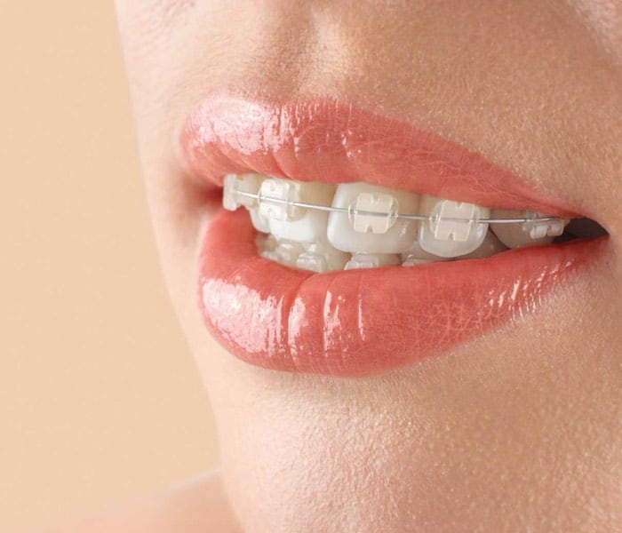 Types of Adult Braces in New Zealand: Choosing the Best Option for a  Straighter Smile