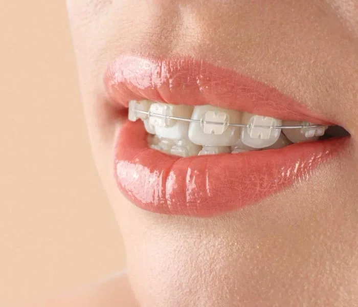 LightForce custom 3D-printed clear braces at Milk Orthodontics Auckland