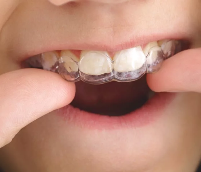 Clear aligners for kids and teens at Milk Orthodontics Auckland