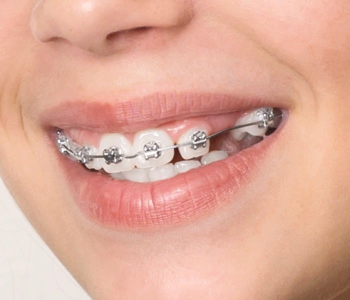 Limited Orthodontic Treatment