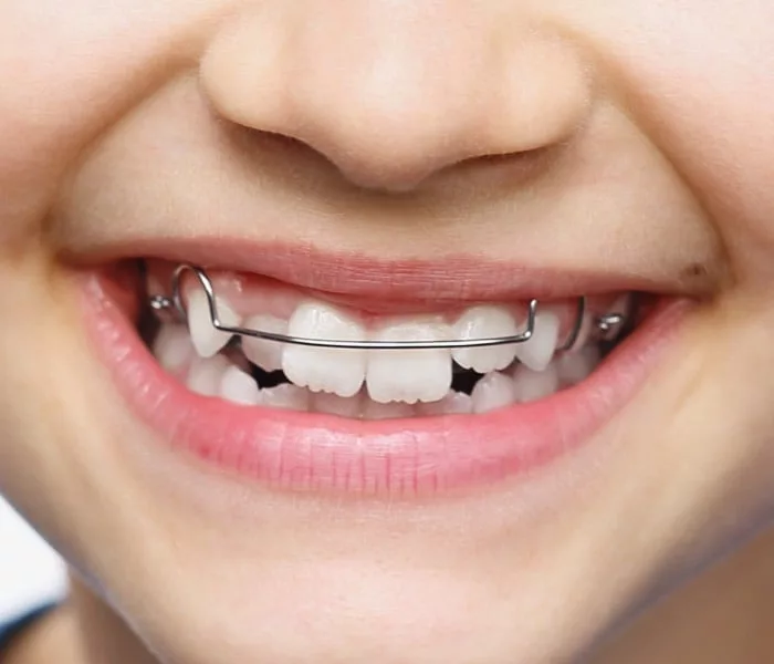 Orthodontic plates and expanders, custom made locally, Milk Orthodontics Auckland