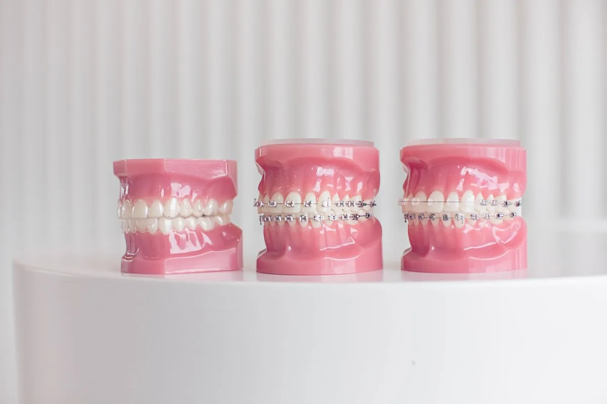 Braces demonstration models at Milk Orthodontics in Newmarket, the closest specialist orthodontist to Epsom