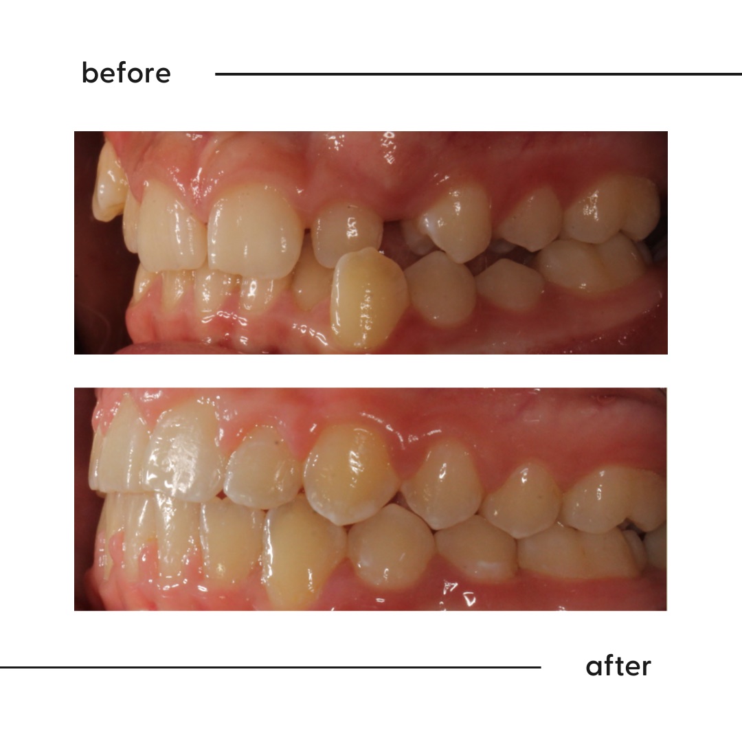 Before and after of a blocked-out canine and anterior crossbite corrected by a specialist orthodontist in Auckland