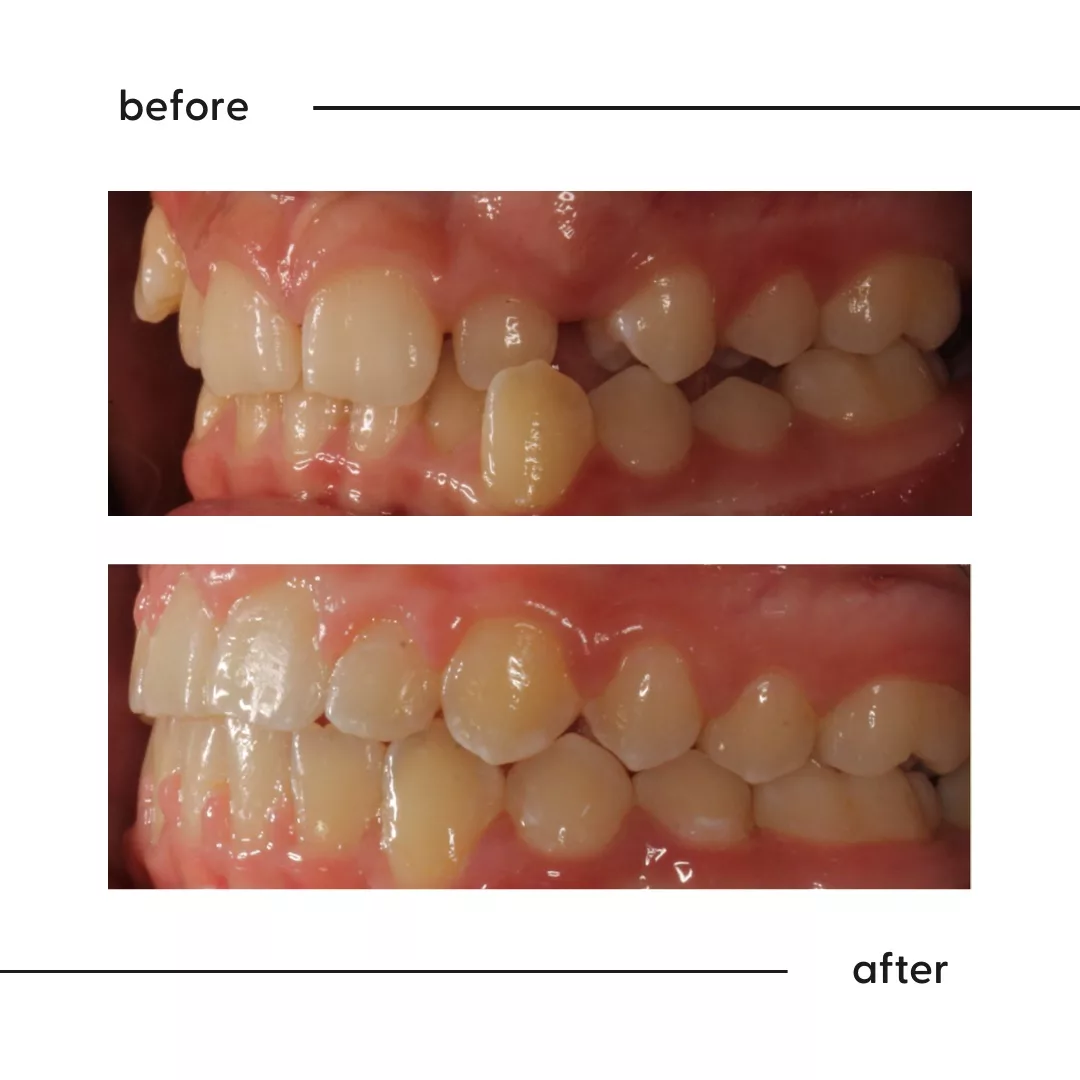 Before and after of a blocked-out canine and anterior crossbite corrected by a specialist orthodontist in Auckland