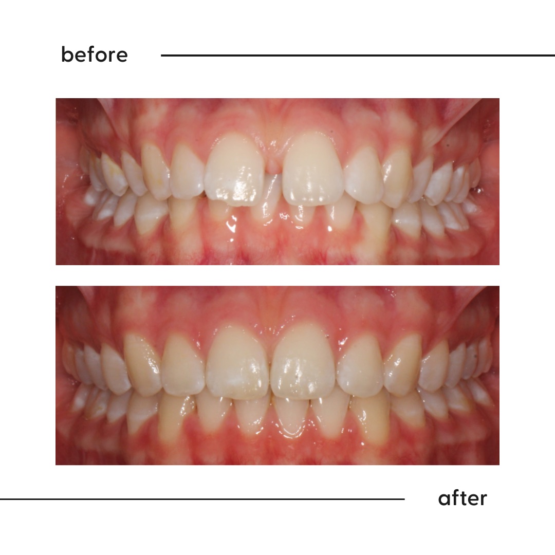 Before and after of protruding buck teeth brought back into line by a specialist orthodontist in Auckland
