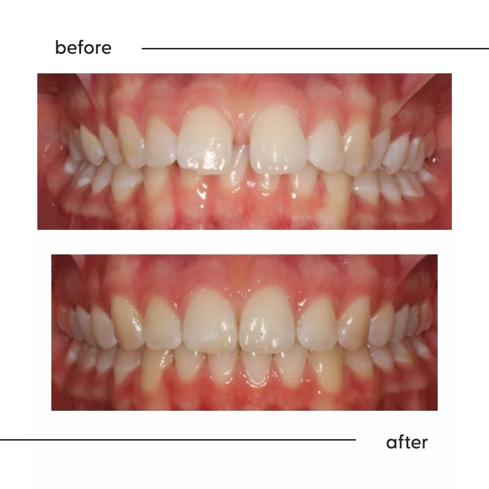 Before and after of prominent, gappy upper front teeth straightened and closed at Milk Orthodontics Auckland