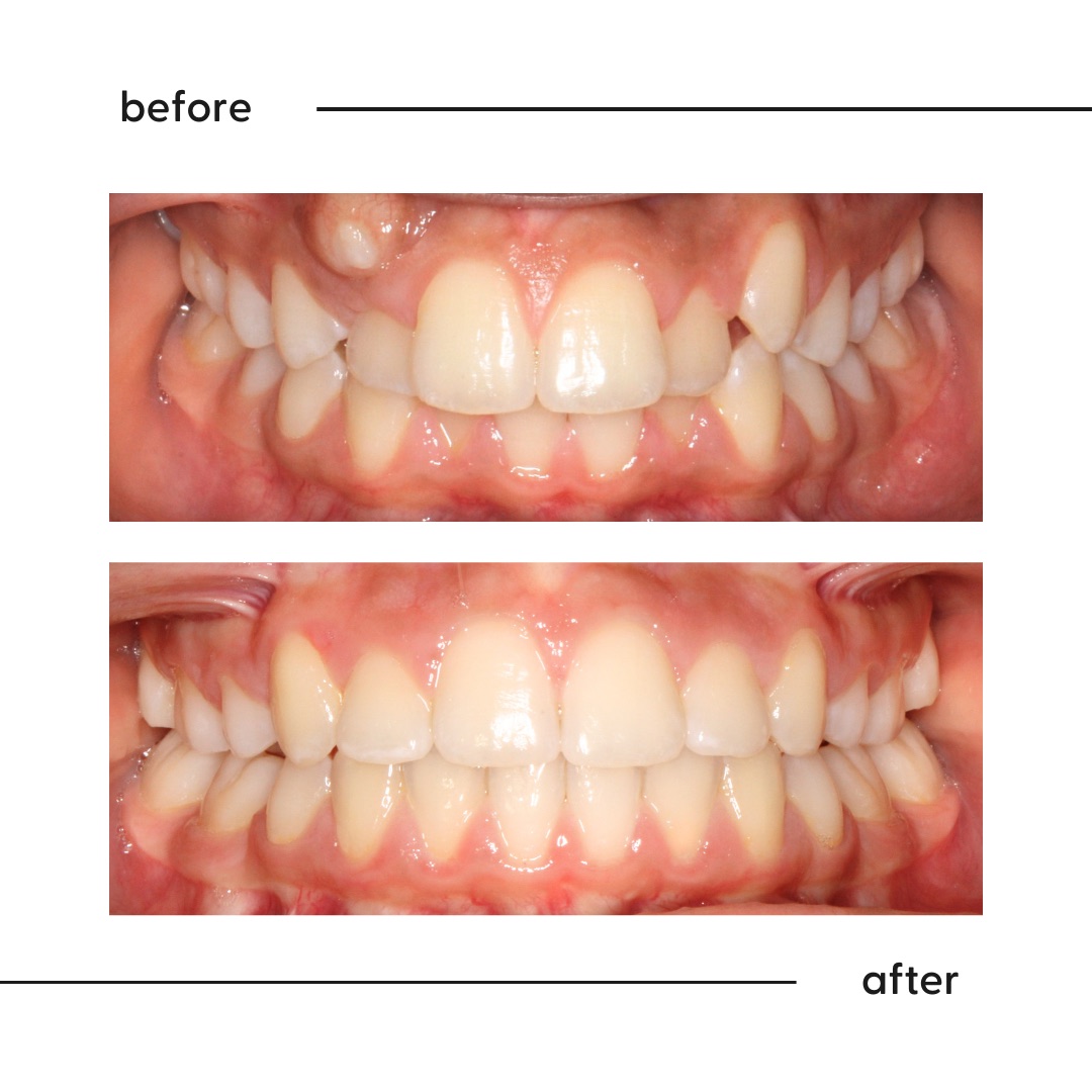 Before and after of high canines, sometimes called vampire teeth, aligned in Auckland