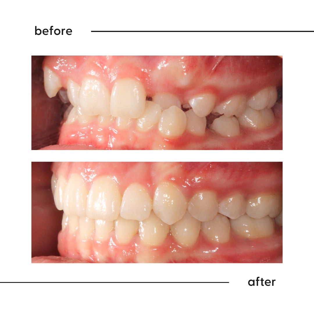 Before and after of a displaced canine and crowding guided into line by a specialist orthodontist in Auckland