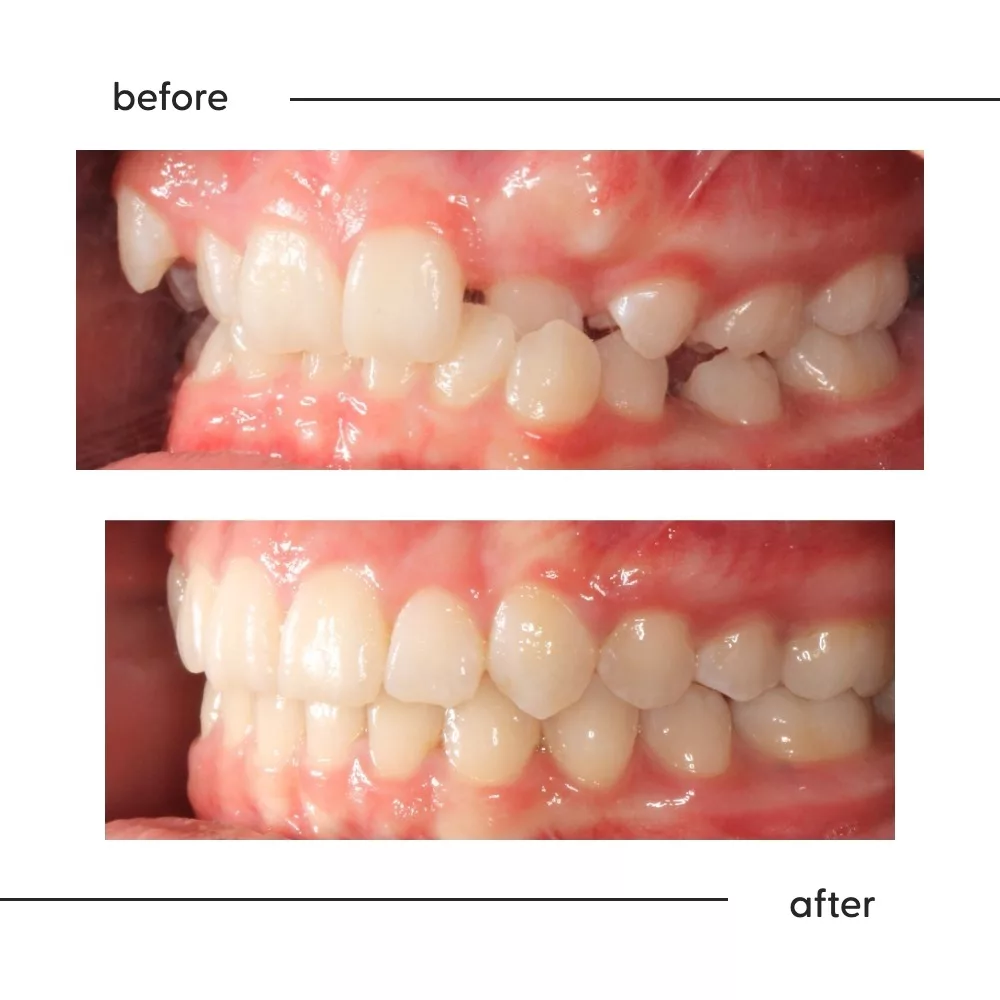 Before and after of an out-of-place canine and crowding aligned by a specialist orthodontist in Auckland