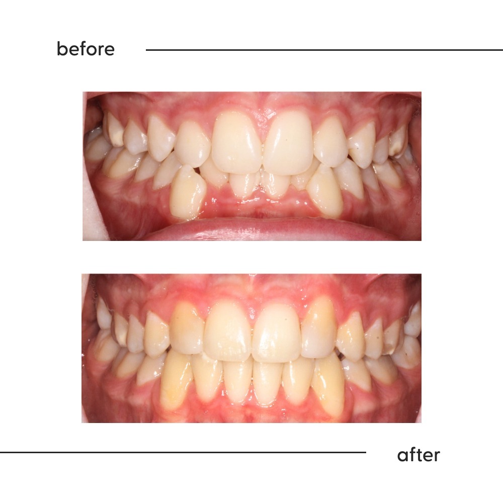 Before and after of missing upper side teeth treated with canine substitution in Auckland
