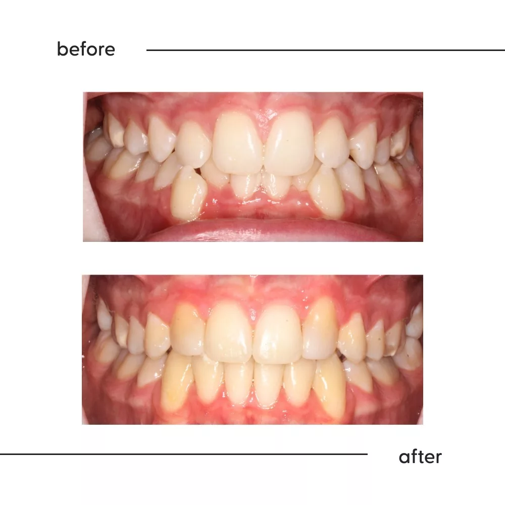 Before and after of missing upper side teeth treated with canine substitution in Auckland
