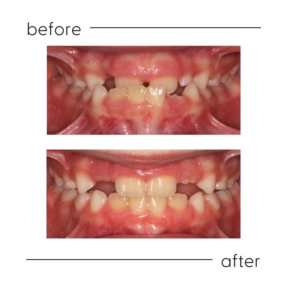 Before and after early interceptive treatment of an anterior crossbite in a young patient at Milk Orthodontics, Auckland