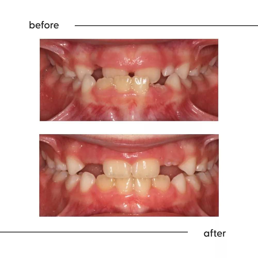 Before and after of a young child's front crossbite corrected with early treatment in Auckland