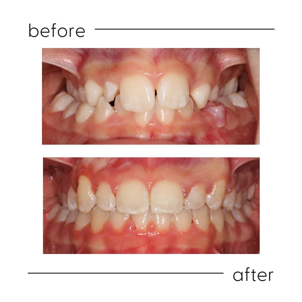 Before and after early treatment of a narrow upper jaw with an expander in a young patient at Milk Orthodontics, Auckland