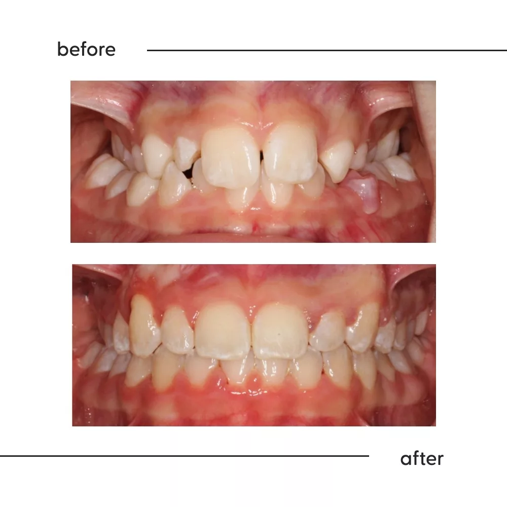 Before and after of a narrow upper jaw widened with an expander, Auckland children's orthodontics