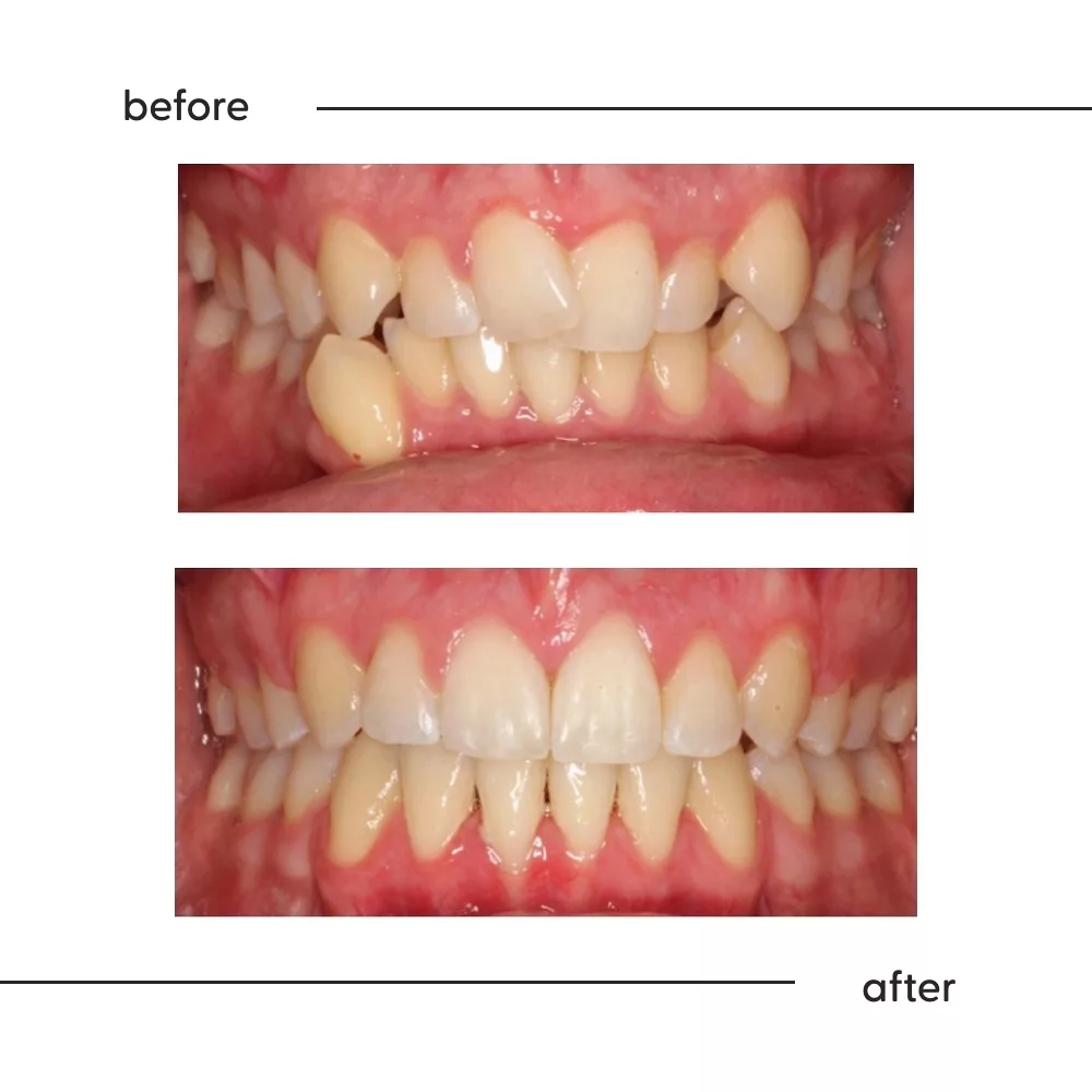 Before and after of severely crowded teeth straightened with braces and extractions in Auckland