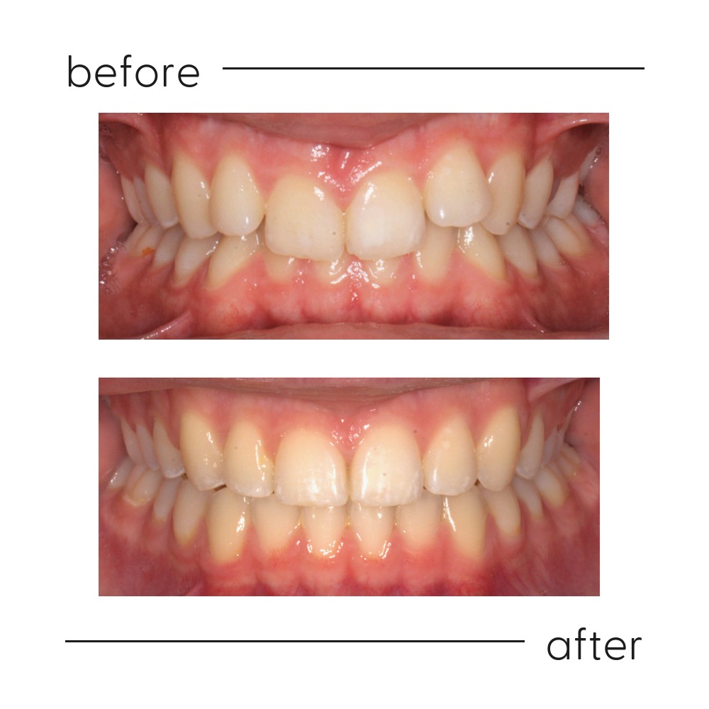Before and after of a deep bite opened so the lower teeth show, by a specialist orthodontist in Auckland