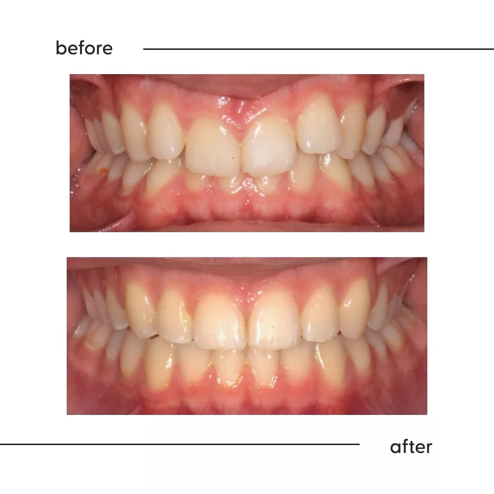 Before and after of a deep bite opened so the lower teeth show, Auckland specialist orthodontics