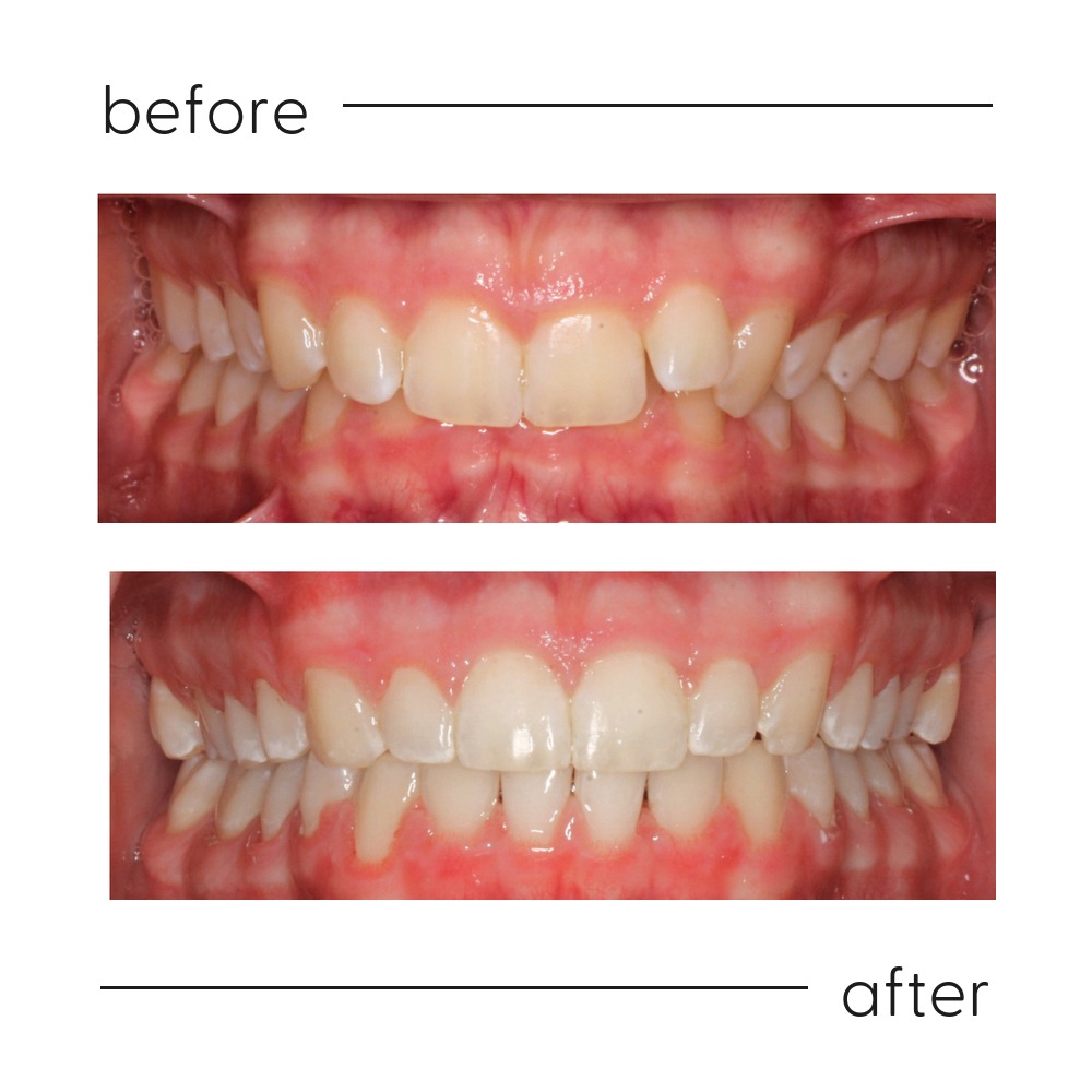 Before and after of a Class II division 2 deep bite corrected in Auckland