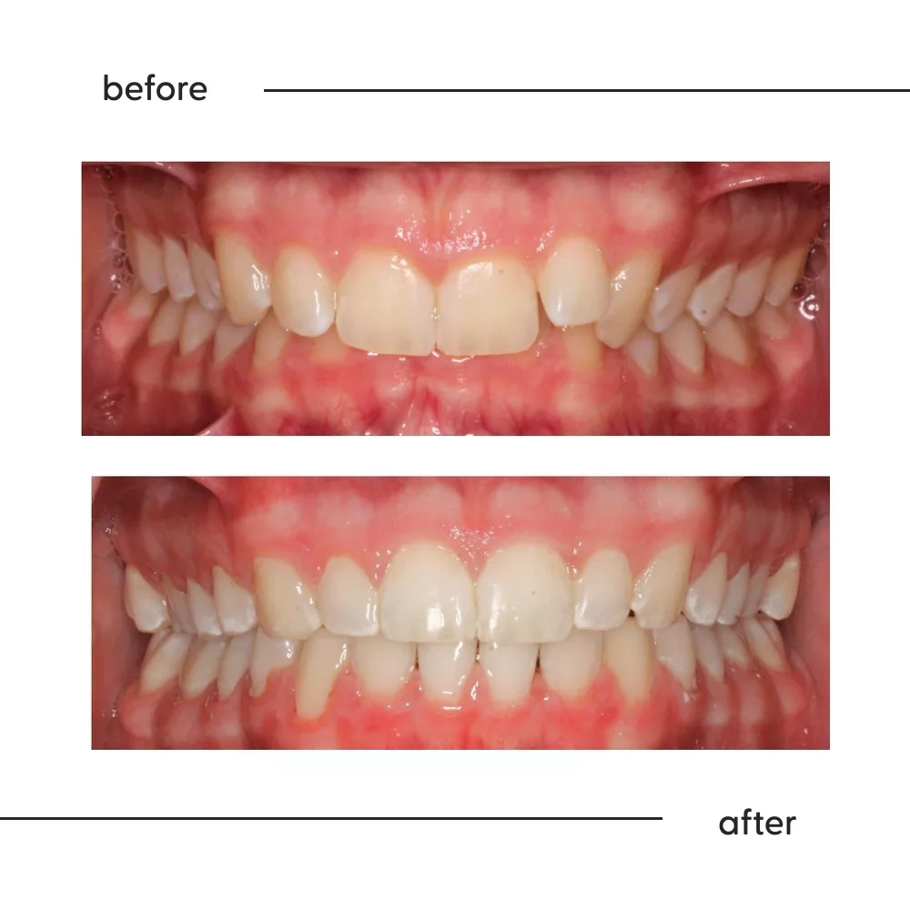 Before and after of a Class II division 2 deep bite corrected in Auckland