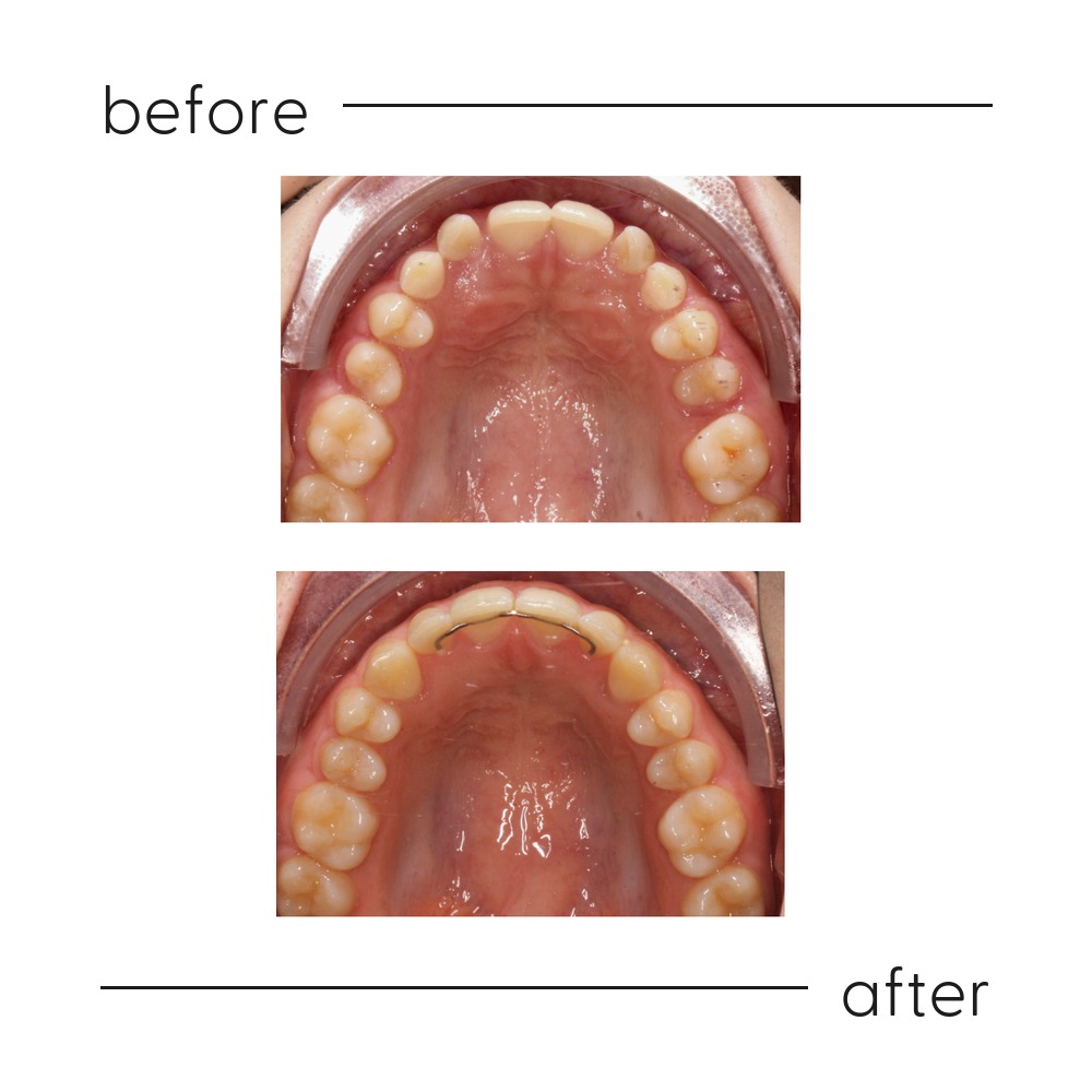 Before and after of impacted canines guided into the dental arch, Auckland specialist orthodontics
