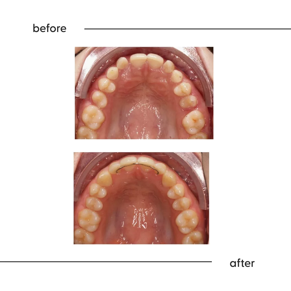 Before and after of impacted canines guided into the dental arch, Auckland specialist orthodontics