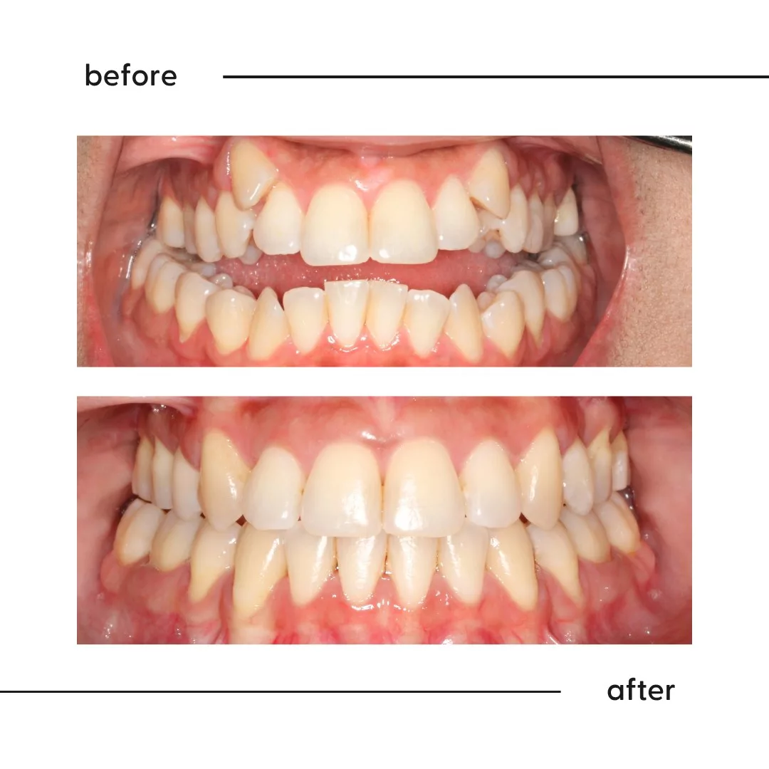 Before and after of an adult open bite corrected by a specialist orthodontist in Auckland