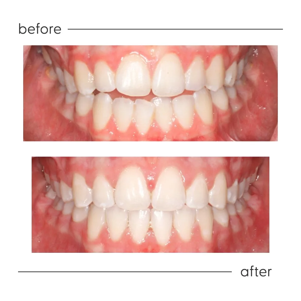 Before and after of an open bite closed at Milk Orthodontics, Auckland