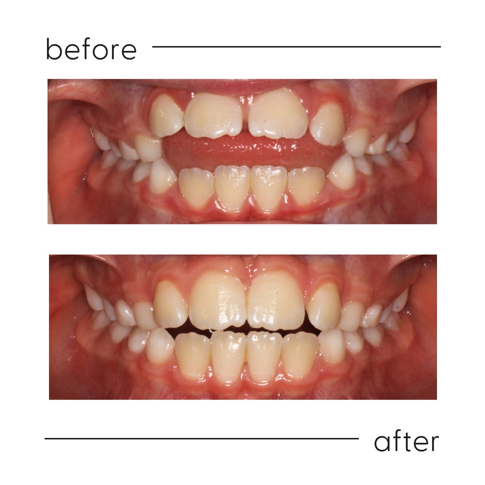 Before and after of an open bite from thumb sucking corrected so the front teeth meet, Milk Orthodontics Auckland