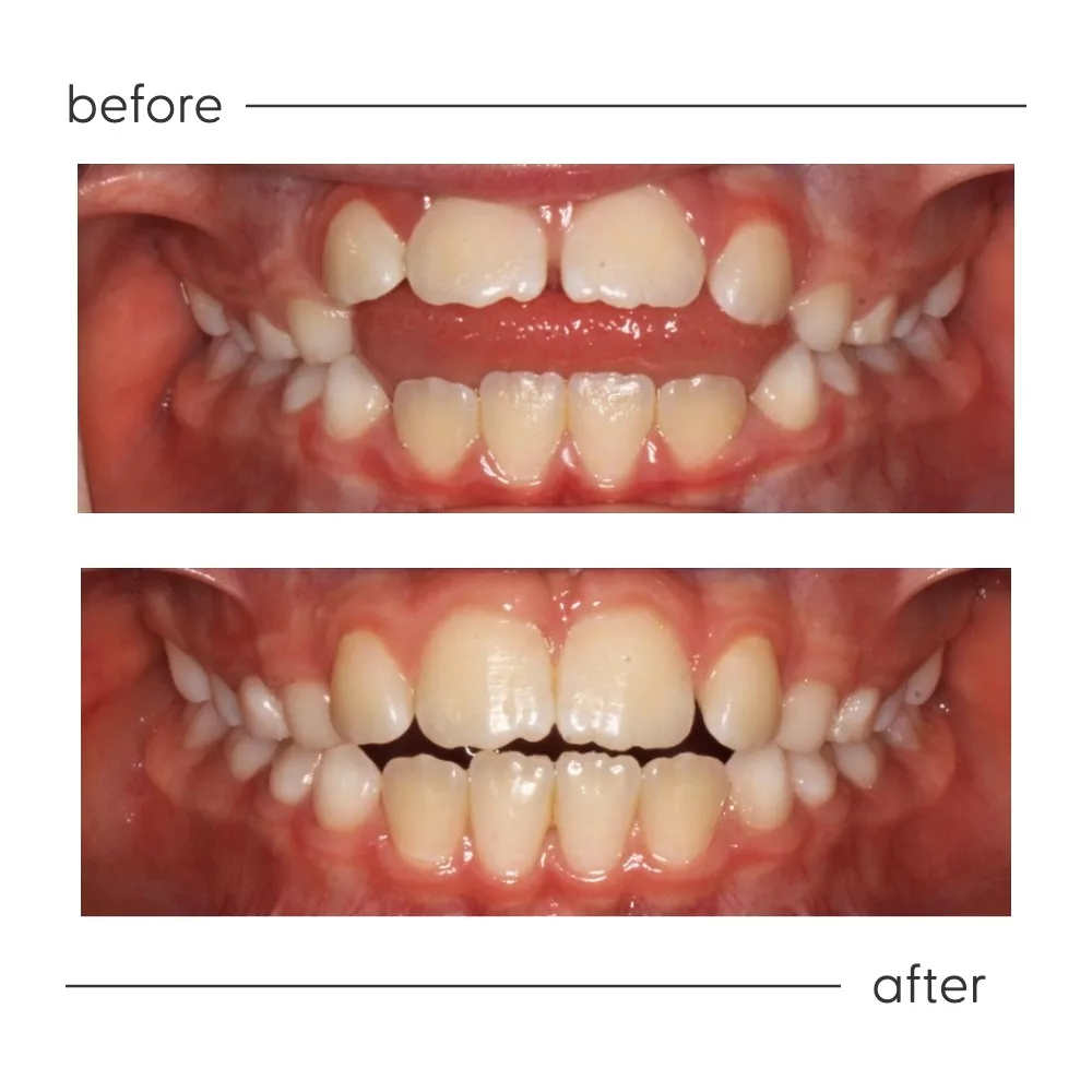 Before and after of an open bite from thumb sucking corrected at Milk Orthodontics, Auckland
