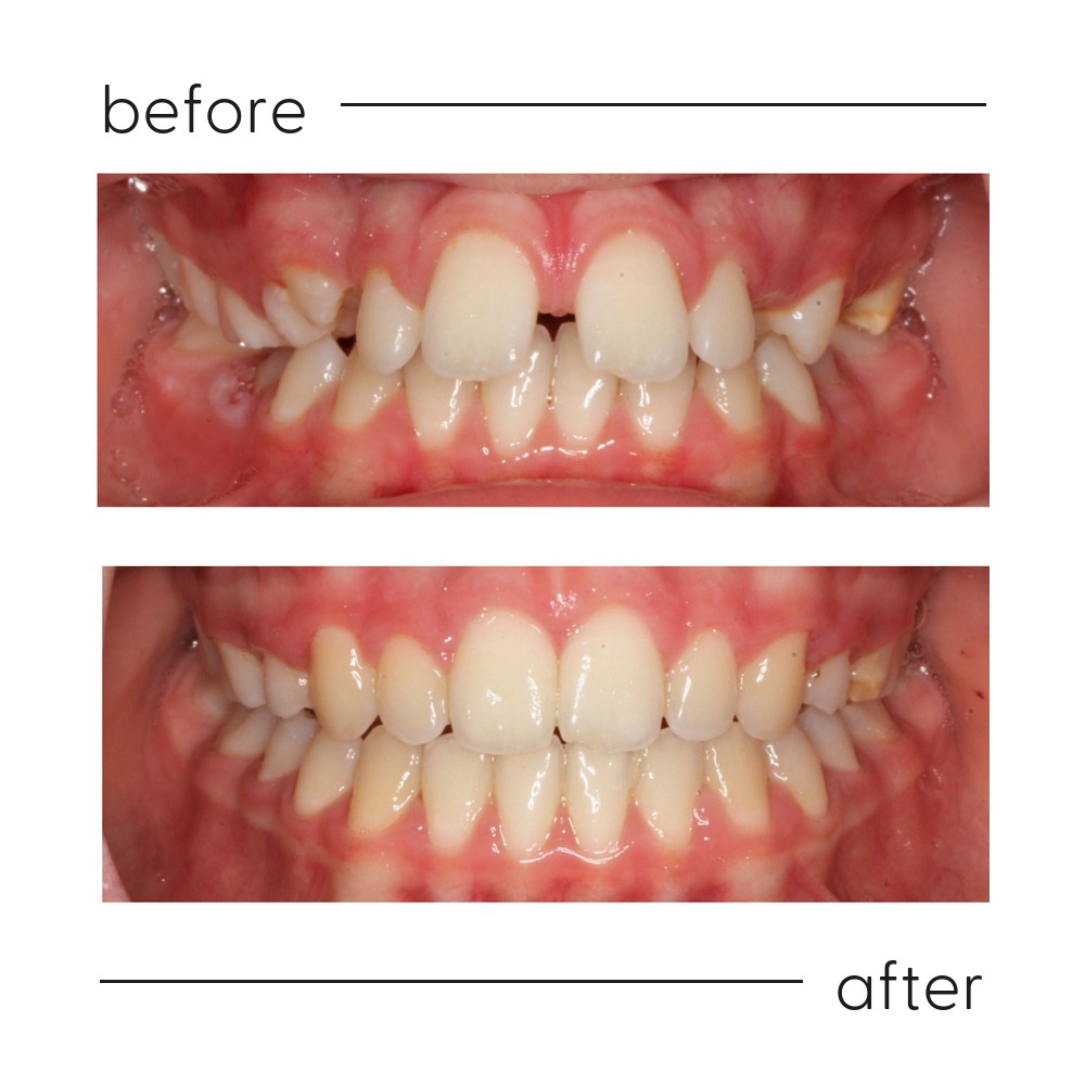 Before and after of a large overjet and overbite corrected in Auckland