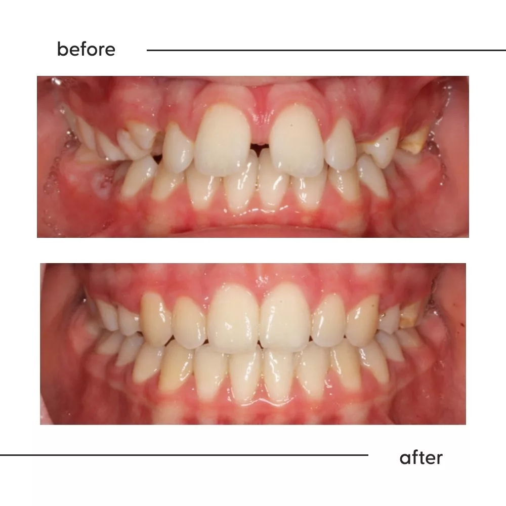 Before and after of a large overbite and overjet corrected by a specialist orthodontist in Auckland