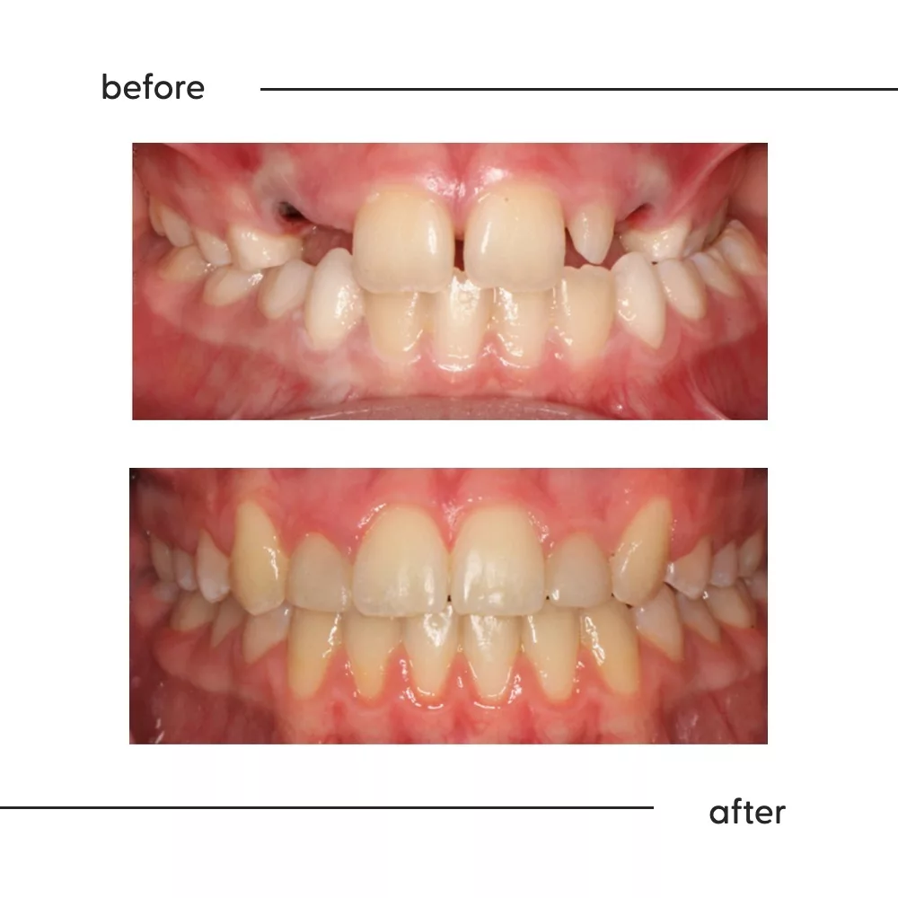 Before and after of small upper side teeth with the spaces closed, Auckland orthodontics