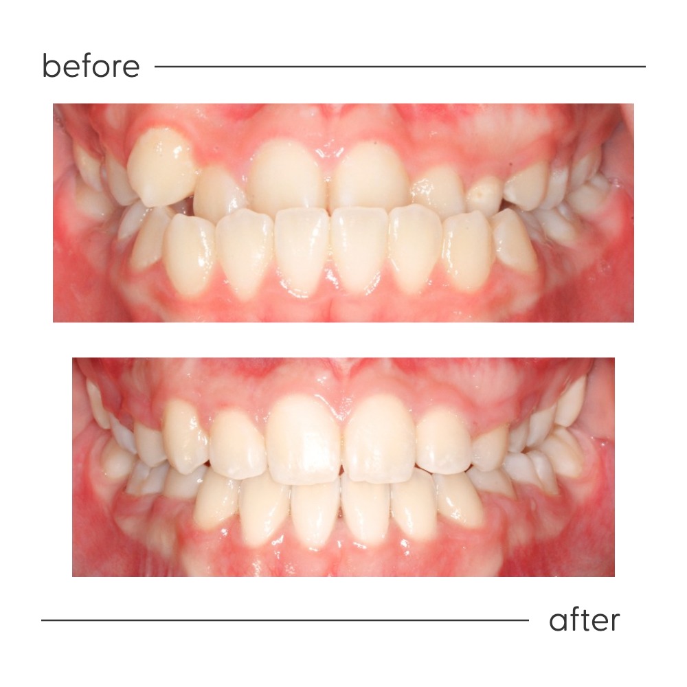 Before and after of an underbite corrected by a specialist orthodontist in Auckland