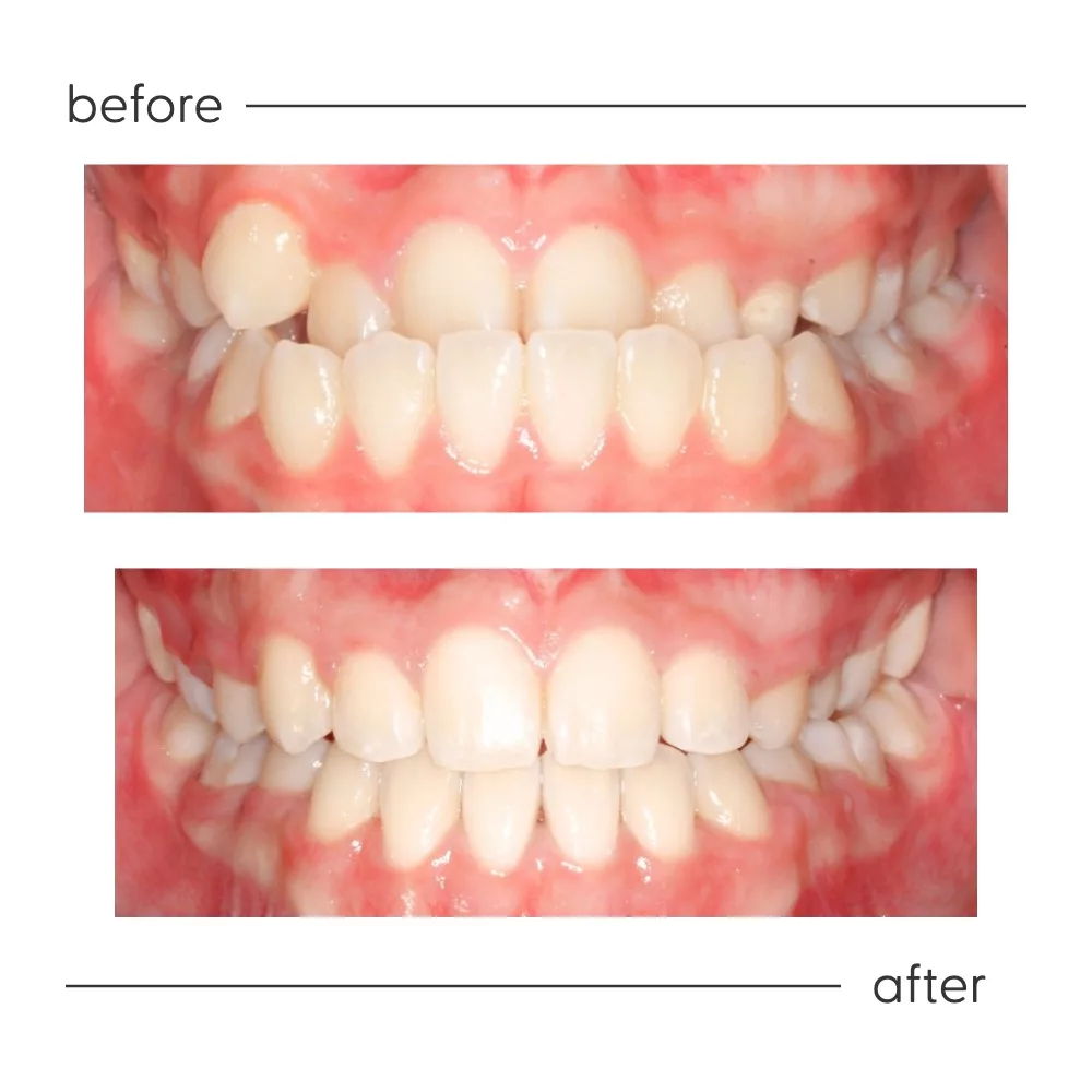 Before and after of an underbite corrected at Milk Orthodontics, Auckland