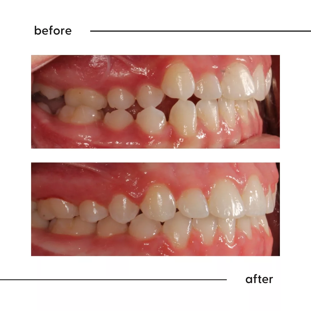 Before and after of a posterior crossbite corrected by a specialist orthodontist in Auckland