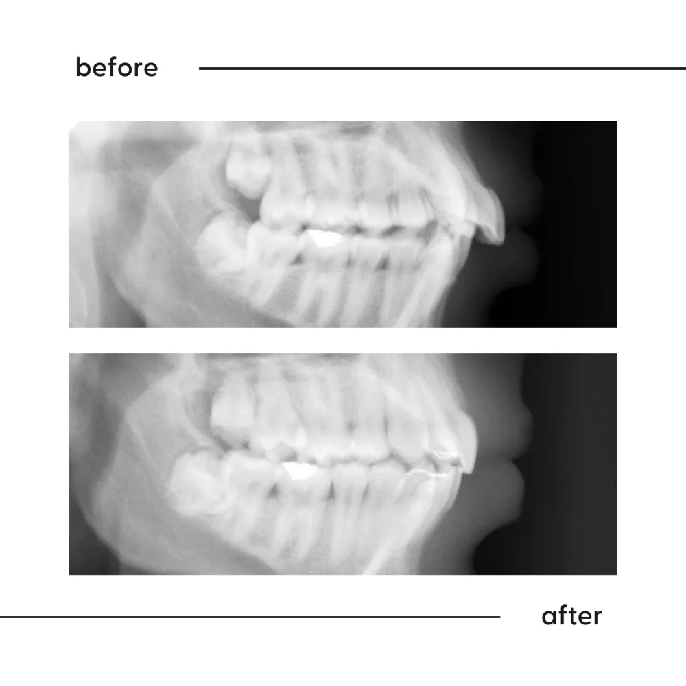 Before and after X-ray of the same patient showing teeth and bite guided into a healthier position