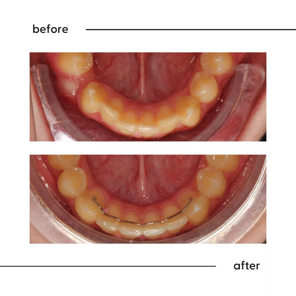 Before and after looking down at a crowded lower arch aligned into a smooth curve, Auckland