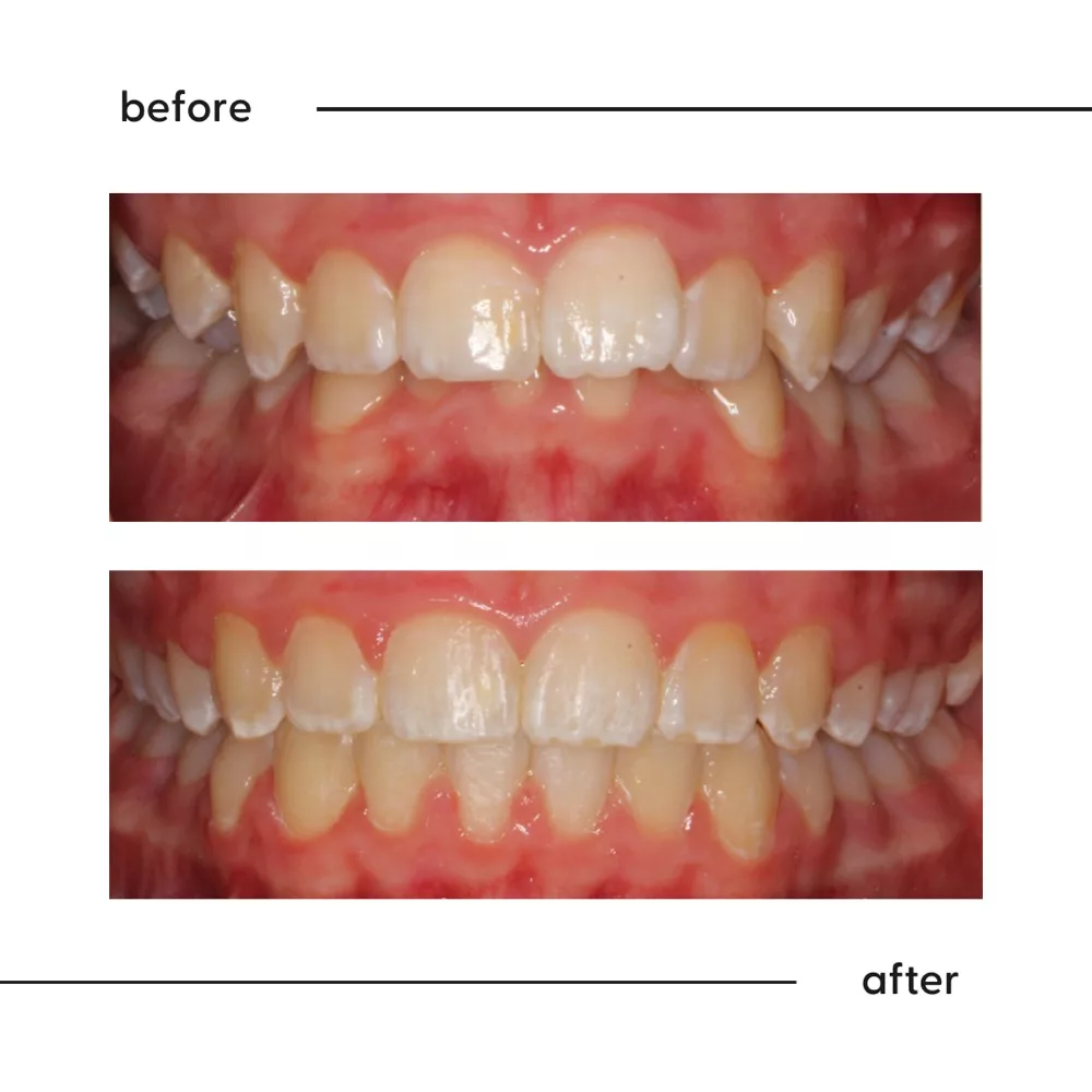 Before and after of a deep bite opened so the lower teeth show, orthodontic result Auckland