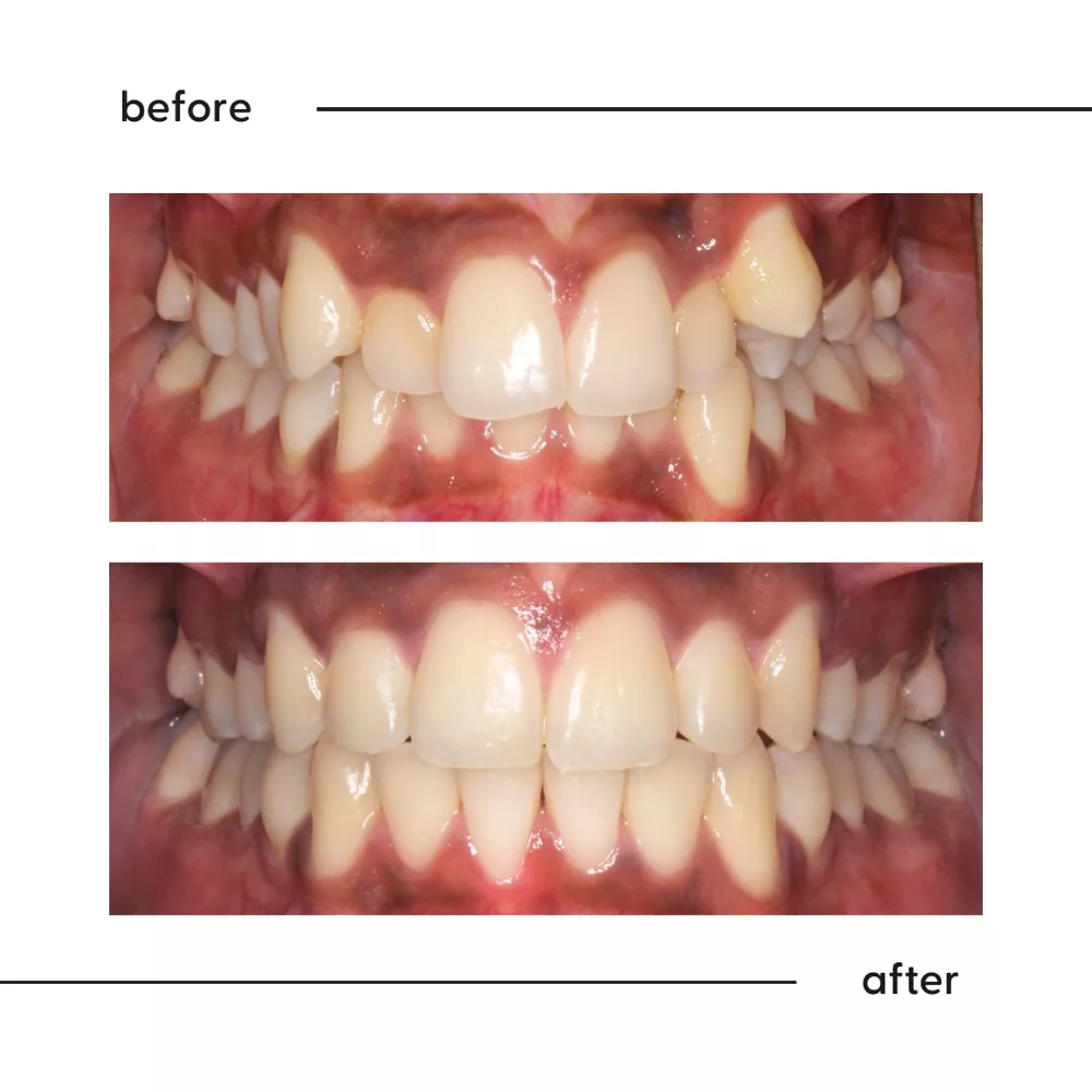 Before and after of a displaced side tooth aligned and a deep overbite corrected, Auckland