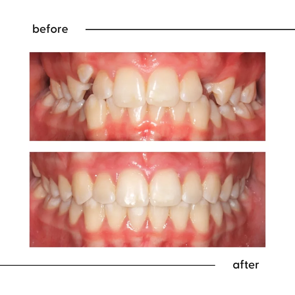 Before and after of a prominent high canine aligned into the smile, Auckland orthodontics
