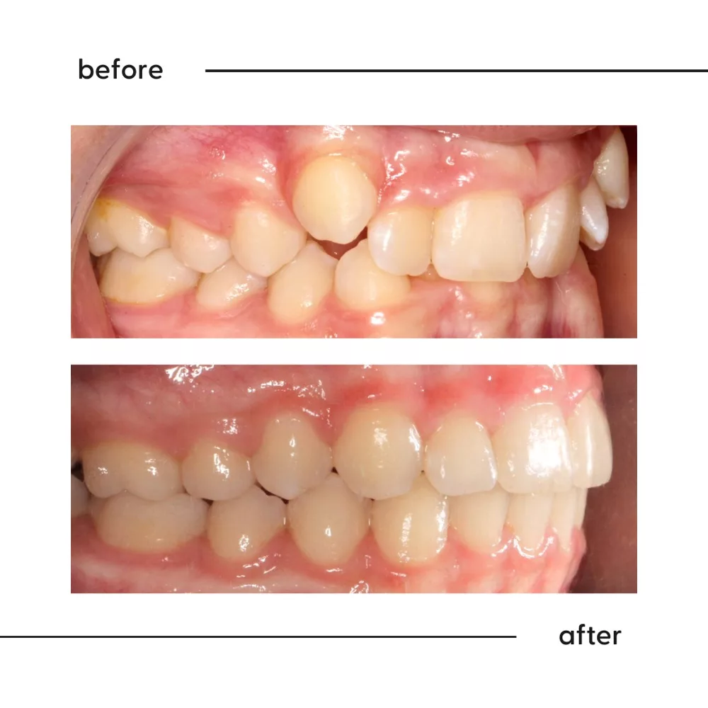 Before and after of a high canine tooth brought down into the smile, Auckland orthodontic result