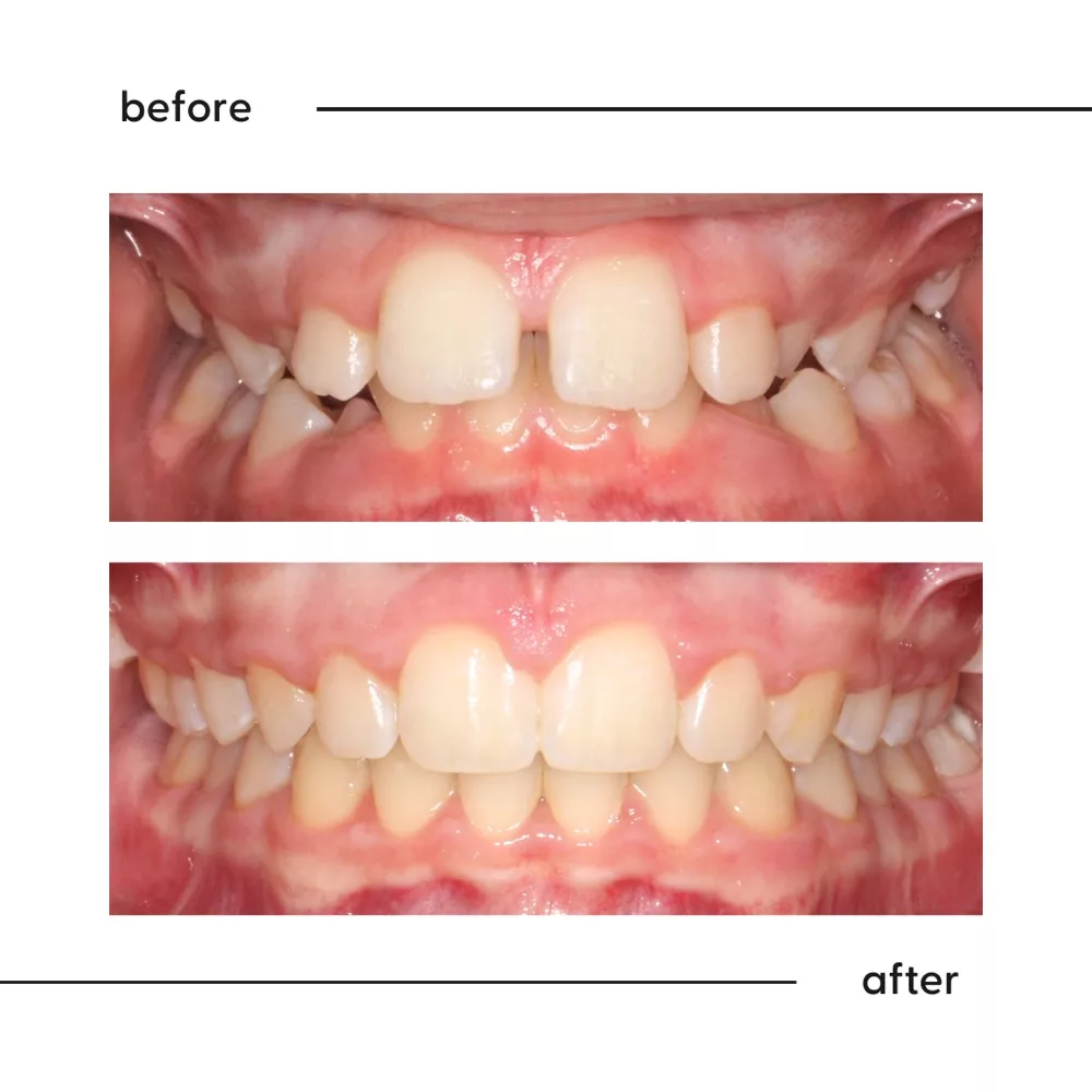 Before and after of a midline gap between the two front teeth fully closed, Auckland